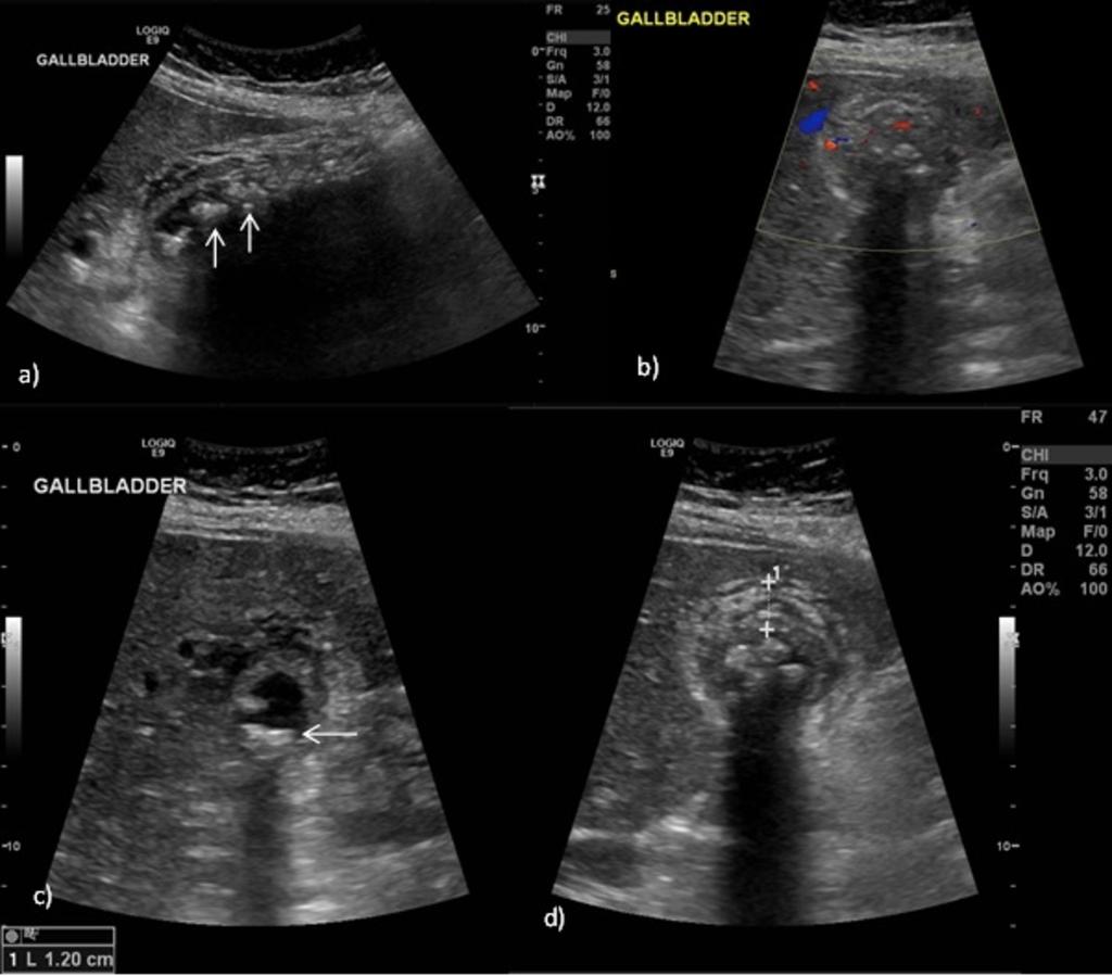 On US, the calcifications are curvilinear and echogenic with posterior acoustic shadowing in the gallbladder fossa.