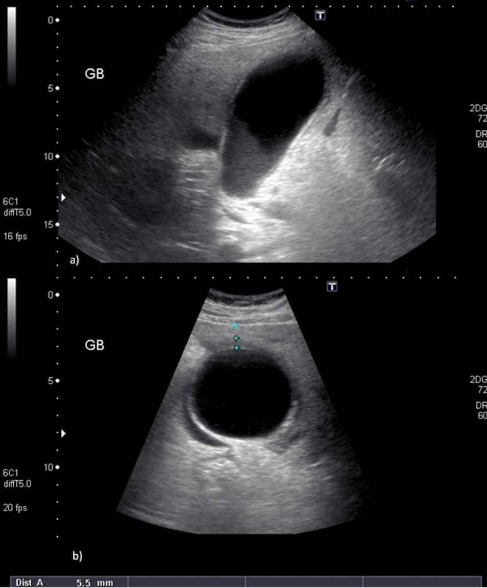 is thickened at 12 mm with significant pericholecystic oedema and mild hyperemia in keeping with acute calculous cholecystitis. Fig.