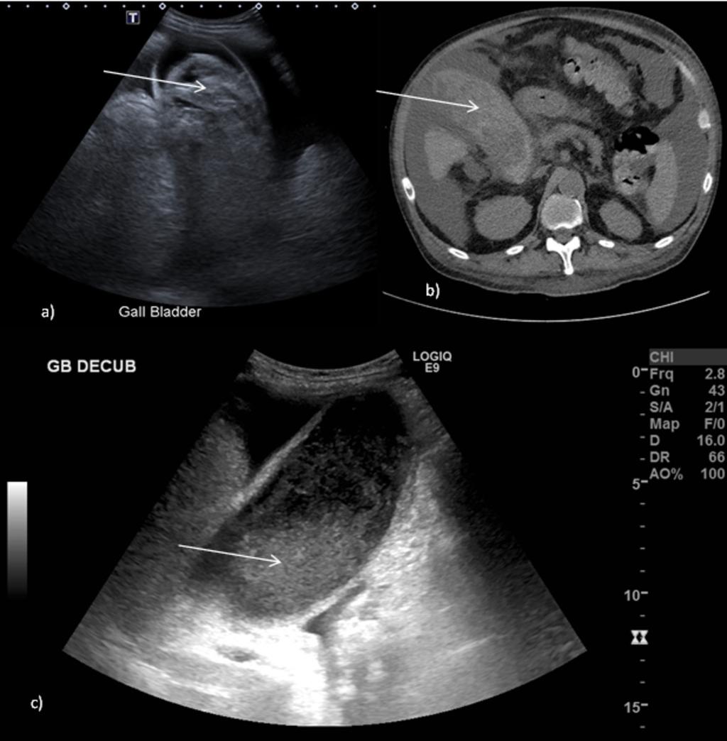 Fig. 4: A and b: Ultrasound longitudinal image (a) of a patient with right upper quadrant pain and guarding on a background of diffuse large B cell lymphoma demonstrates nonmobile heterogenous