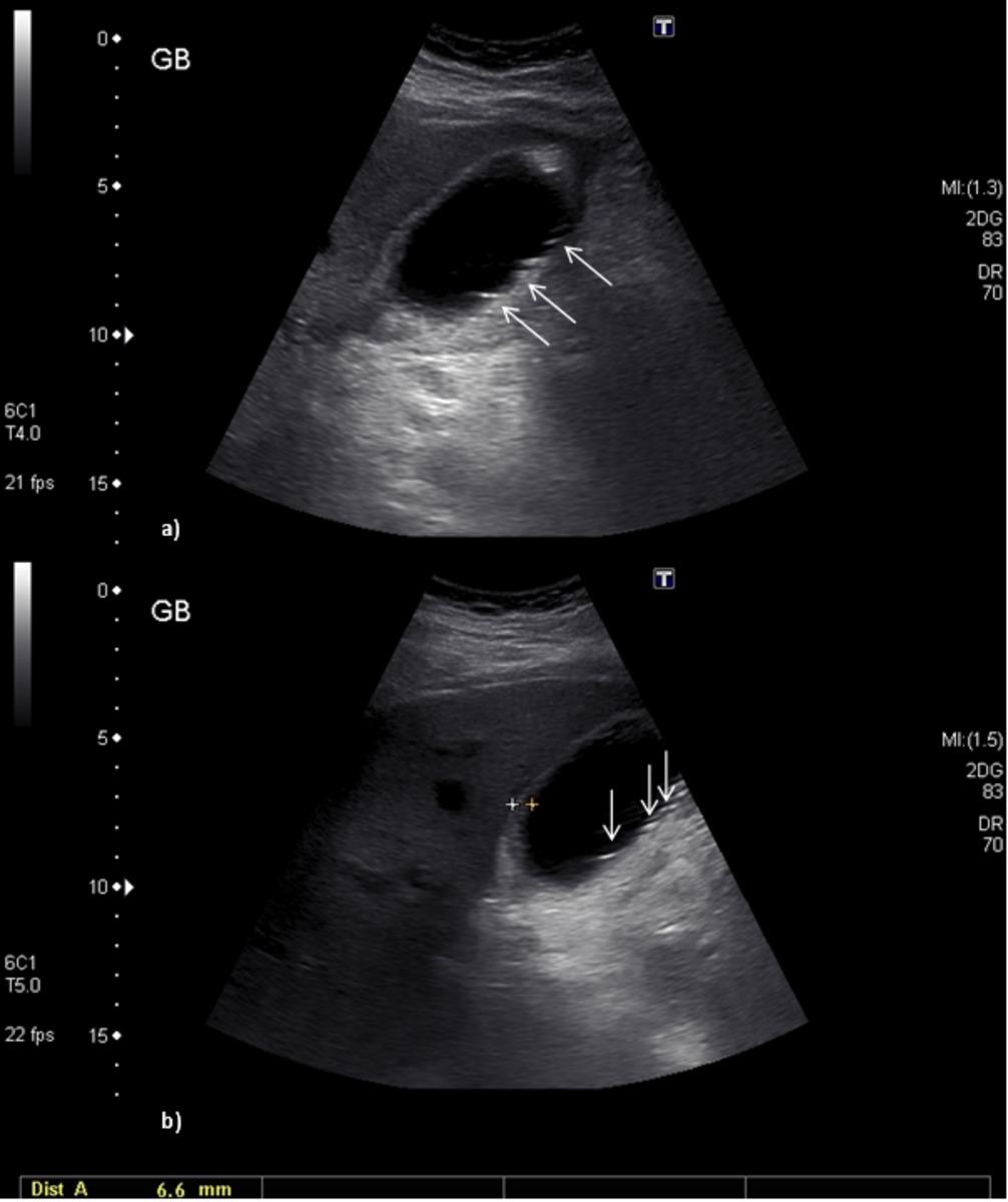 Fig. 7: A and b: Ultrasound longitudinal images of a patient with right upper quadrant pain and vomiting.