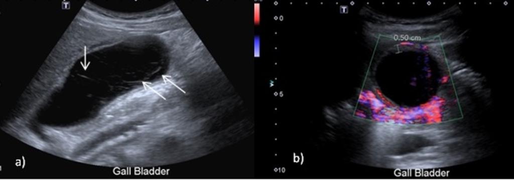 Fig. 8: A and b: Ultrasound longitudinal and axial images of a patient with 3 days of right upper quadrant pain and vomiting.