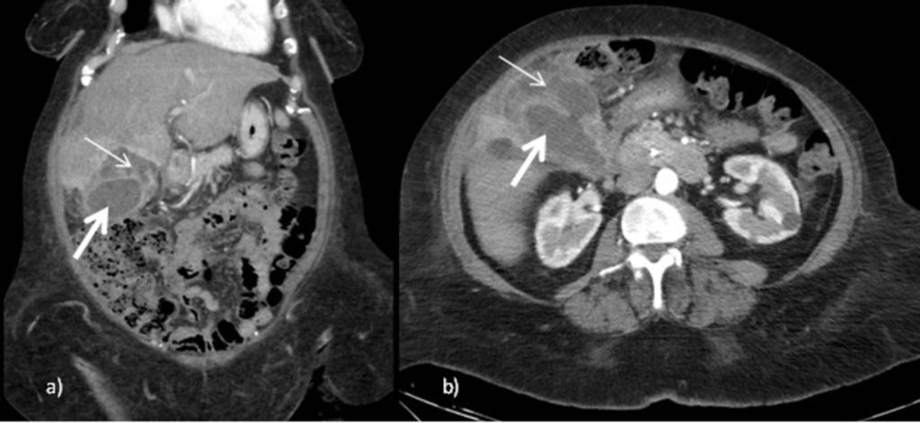 9: A and b: CT Abdomen Portal Venous phase coronal and axial images of a patient 1 month post stent insertion for cholecystitis and