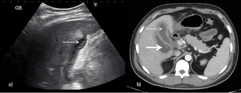 Fig. 10: A: Ultrasound longitudinal image of a patient with acute pancreatitis post alcoholic binge. The gallbladder is totally collapsed with no calculus identified (thin arrow).