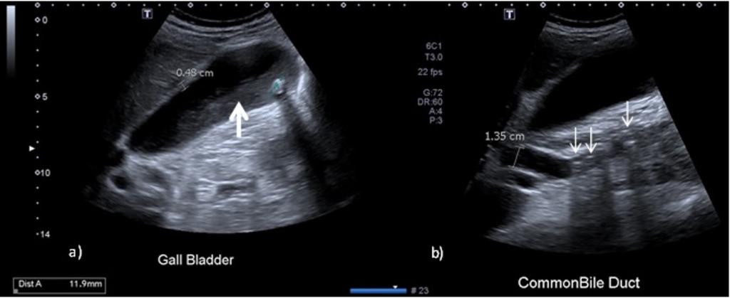 arrow). Fig. 11: A and b: Ultrasound longitudinal images of a 72 year old man with 3 days of constant right upper quadrant abdominal pain.