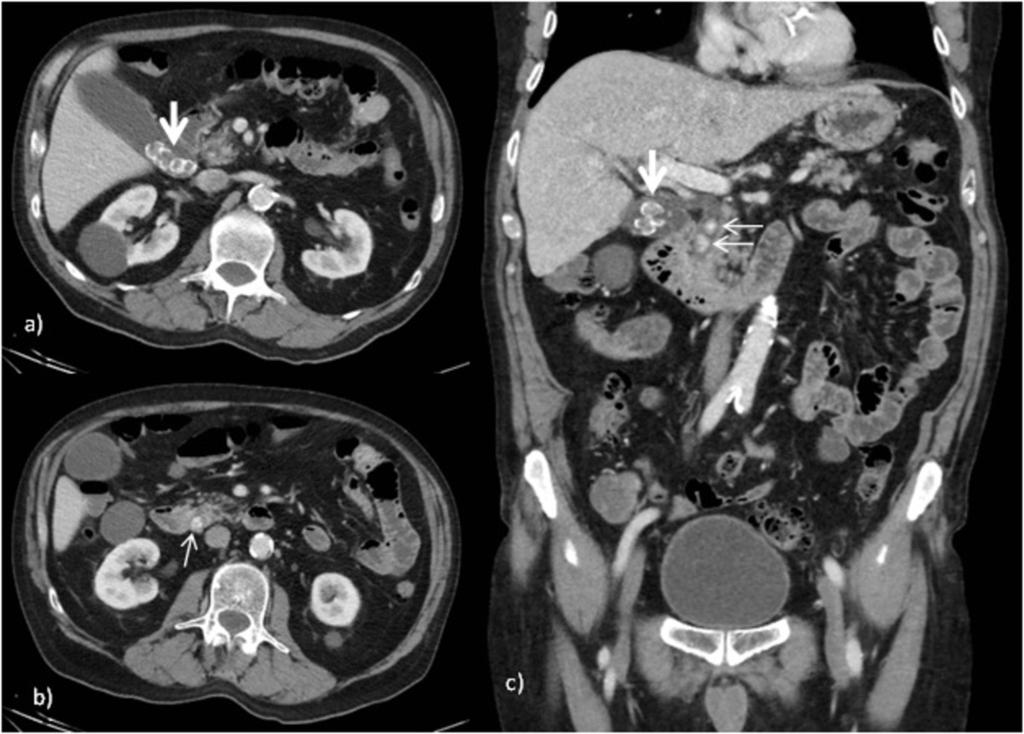 Fig. 12: A, b and c: CT Abdomen Portal Venous phase axial and coronal images of a patient with abdominal pain and deranged liver function tests.