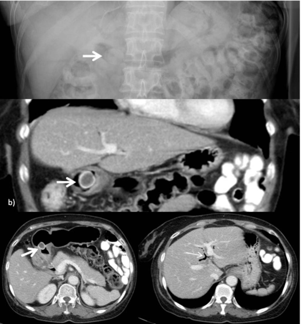 Fig. 13: A: Supine abdominal radiograph of a patient with right upper quadrant pain and deranged liver function tests demonstrating the gallstone (thick arrow) within the distal stomach.