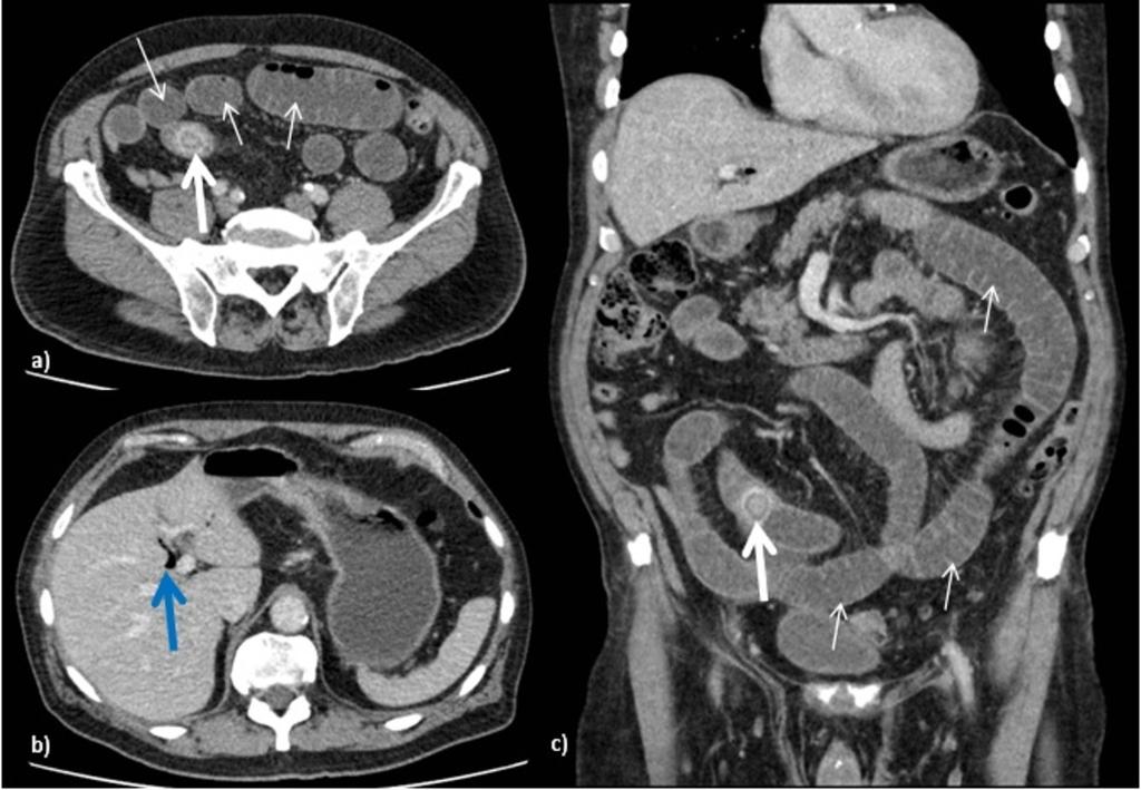 Fig. 14: A, b and c: CT Abdomen Portal Venous phase axial and coronal images of a patient with abdominal pain and vomiting.