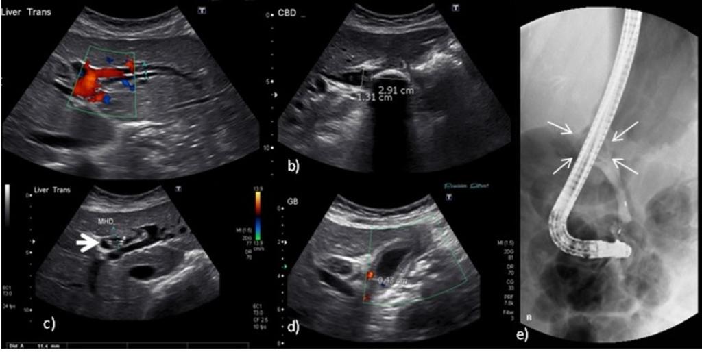 Fig. 16: A and b: CT Abdomen Portal Venous phase axial and coronal images of a patient with abdominal pain demonstrating intramural gallbladder gas (thin arrow).