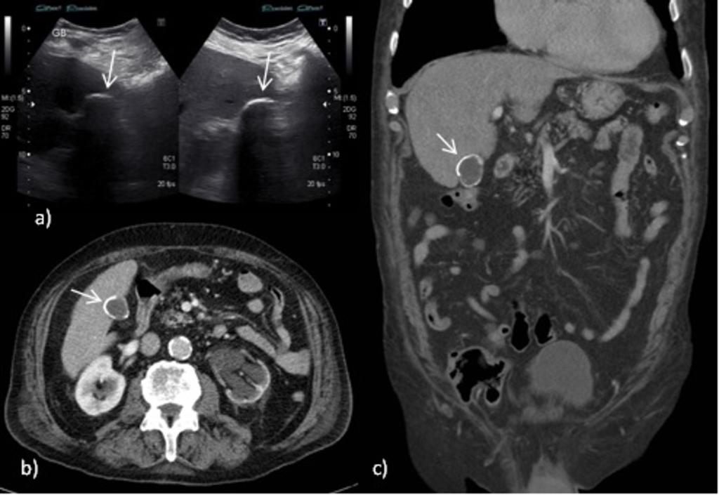 Fig. 18: A, b and c: CT Abdomen Portal Venous phase axial and coronal images of a patient with epigastric pain and deranged liver function tests on a background of previous cholecystectomy.