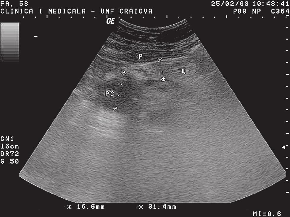 268 Rogoveanu et al Fig.7 Transabdominal ultrasonography: ampullary carcinoma.