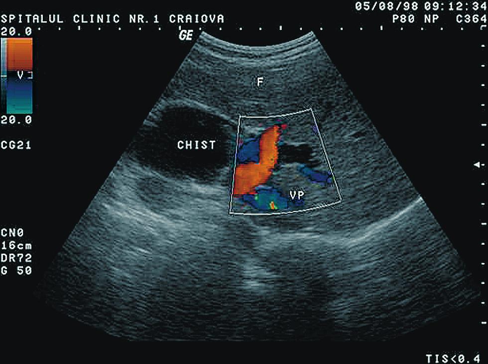 15 Transabdominal ultrasonography: pancreatic head adenocarcinoma. Fig.