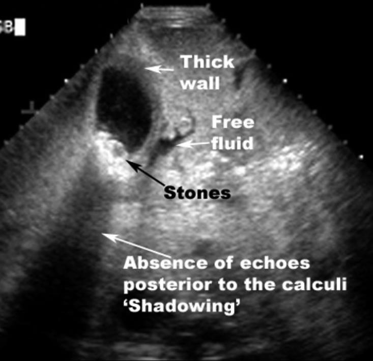 Acute Cholecystitis: Ultrasound Findings Gallbladder wall thickening >3mm Pericholecystic fluid