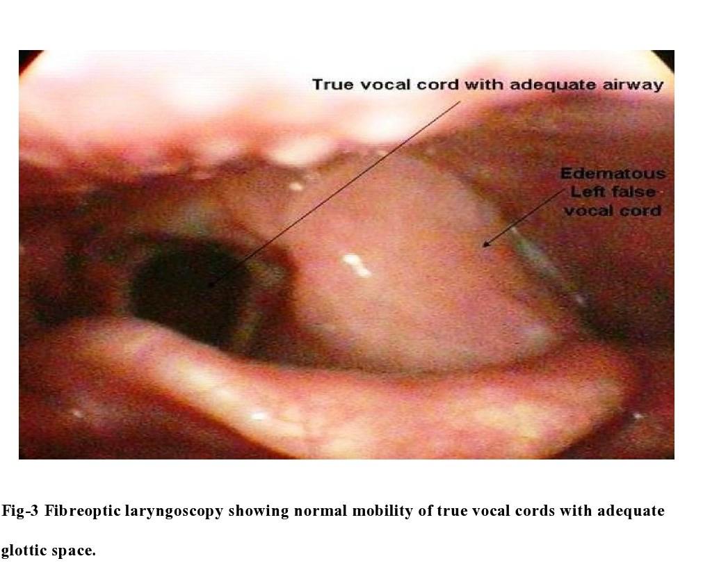 Obstructive supraglottic schwannoma: a case report and review of the literature. Laryngoscope.