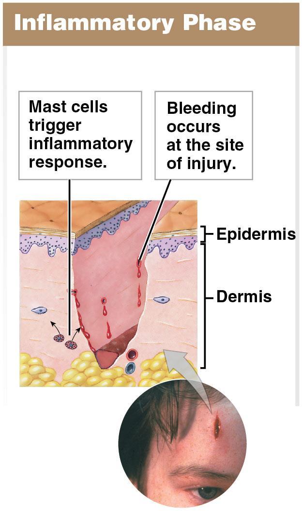 Module 5.12: CLINICAL MODULE: The integument can often repair itself, even after extensive damage Four phases in skin regeneration after injury 1.