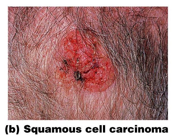 Squamous Cell Carcinoma Metastasizes to lymph nodes if not removed Early removal