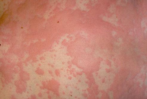 Urticaria ( Hives ) 10-20% incidence in general population Pruritic, white or erythematous, blanchable cutaneous elevations