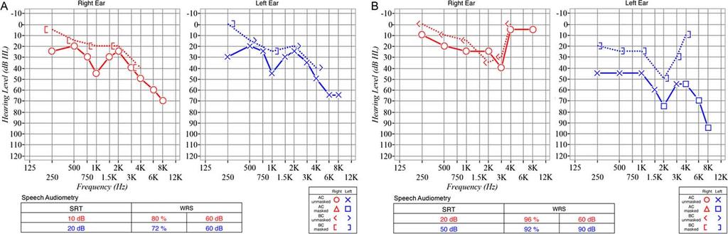 Fig. 1. (A) Case 1 audiogram showing symmetric, progressively downsloping mild to moderately severe mixed but predominantly sensorineural hearing loss.