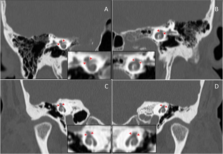 Fig. 3. Coronal computed tomography temporal bone showing the lack of bony margin and merging of the overlying facial canal and cochlea (arrowheads). (A) Case 1 right side. (B) Case 1 left side.