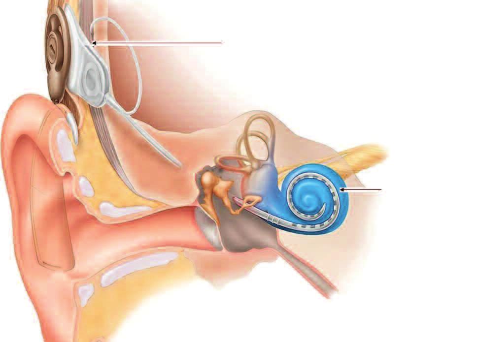 How does a cochlear implant work? Receiver/Stimulator Package Cochlea with electrode array in-situ Courtesy of Cochlear Ltd. Figure 2.