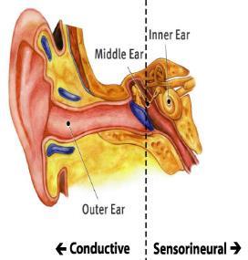 Conductive deafness