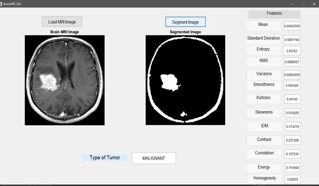 Figure 5 Result of a brain MRI of malignant type CONCLUSION An image in the jpeg format of the provided MRI brain image in Dicom format is obtained.