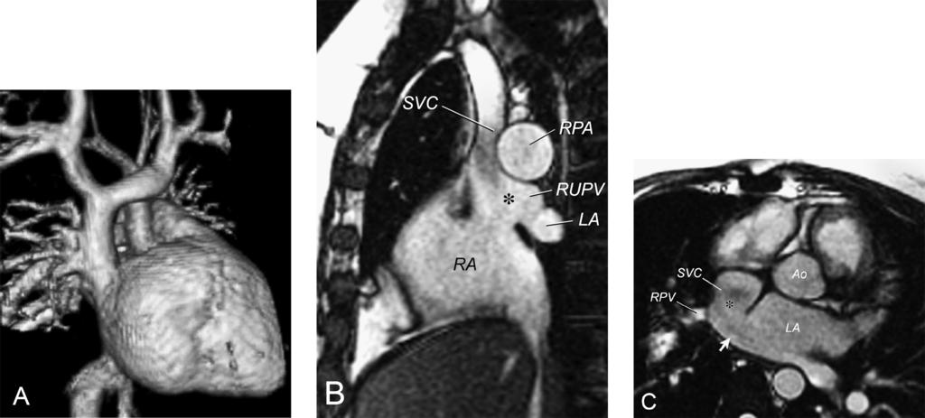 Figure 3. Sinus venosus defect. A. Three-dimensional reconstruction of a gadolinium-enhanced 3D MRA showing several pulmonary veins from the right upper lobe draining into the superior vena cava. B.