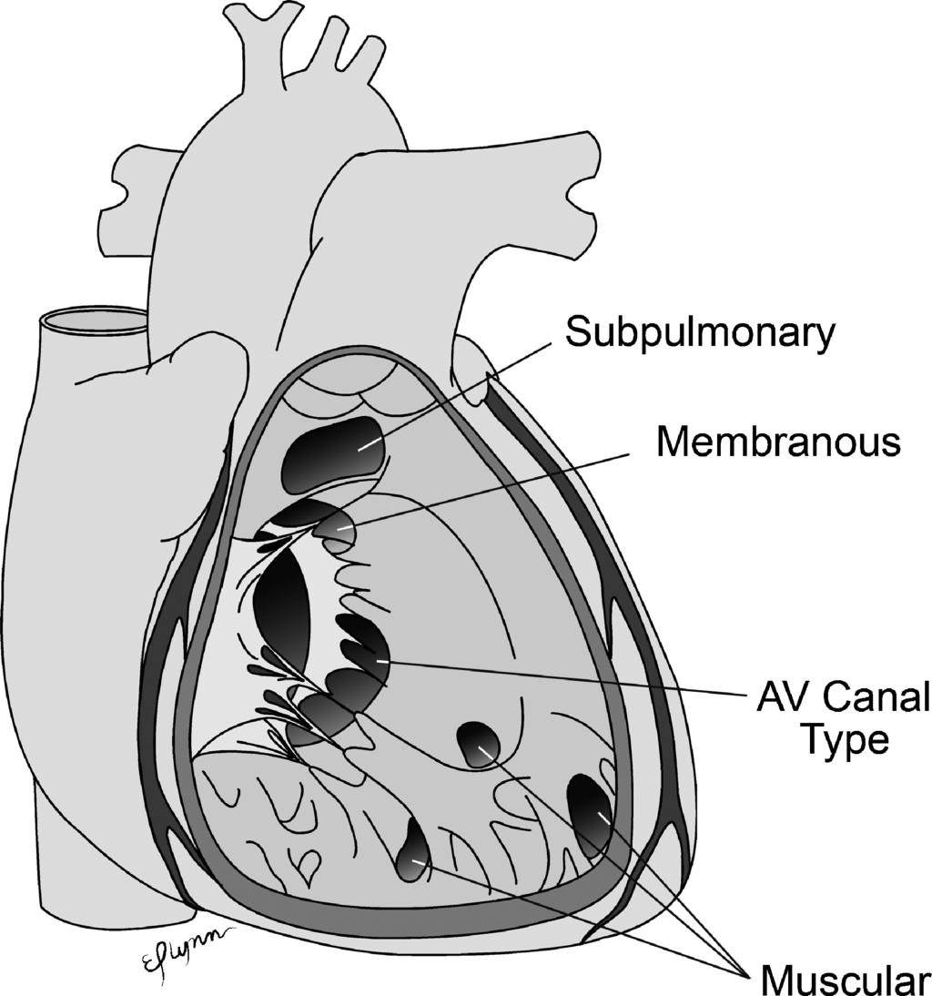 echocardiography but agreed with surgical results. Rim distance to the coronary sinus and minor septal fenestrations <1 mm were difficult to identify by CMR.