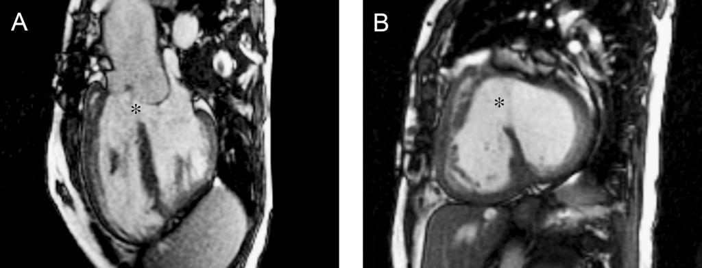 Figure 6. Malalignment conoventricular septal defect ( ) imaged with ECG-gated steady state free precession cine MRI in ventricular long-axis (A) and short-axis (B).