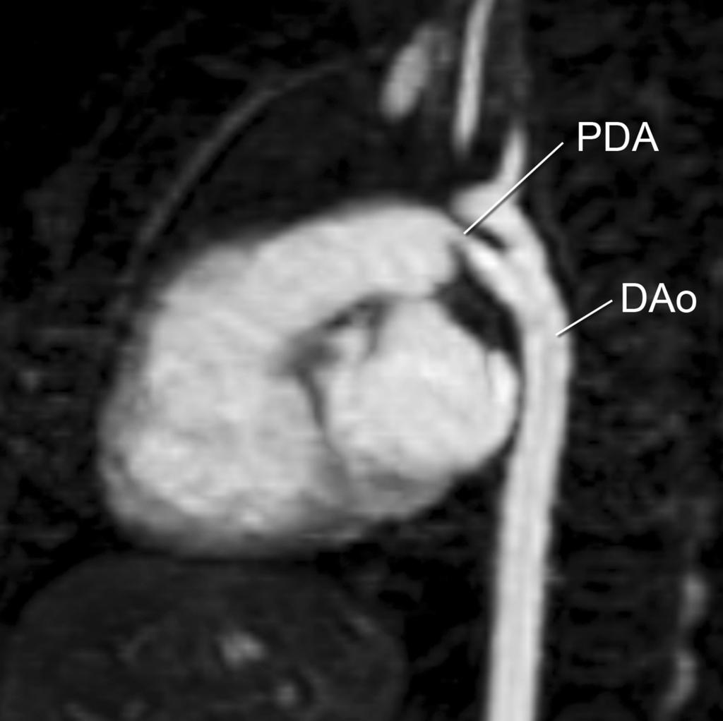 Figure 7. Gadolinium-enhanced 3D MRA (oblique sagittal subvolume maximal intensity projection) in an infant illustrating a patent ductus arteriosus (PDA). DAo-descending aorta.