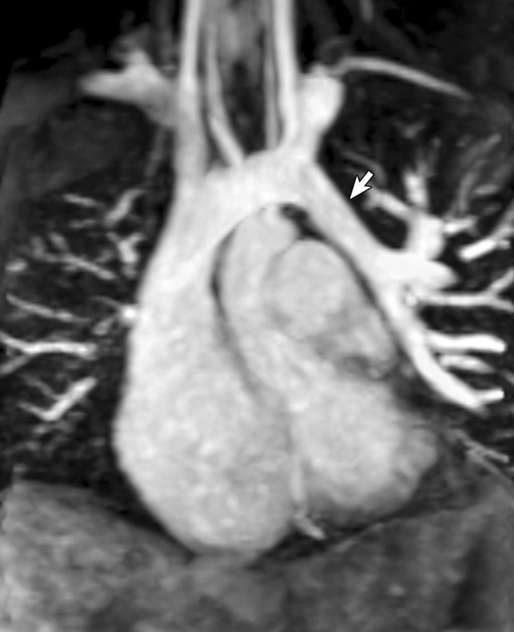 Figure 9. Gadolinium-enhanced 3D MRA (oblique coronal subvolume maximal intensity projection) in an adult with scimitar syndrome. Figure 8.