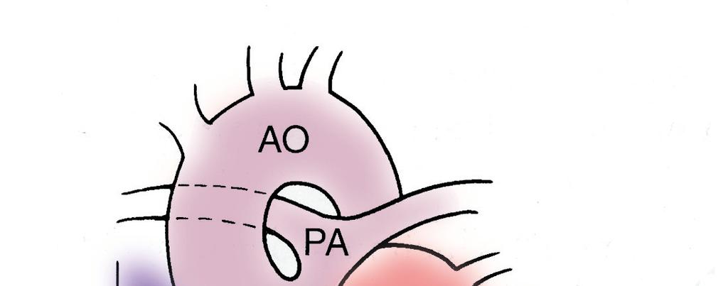 Truncus arteriosus Aorta, pulmonary arteries, and
