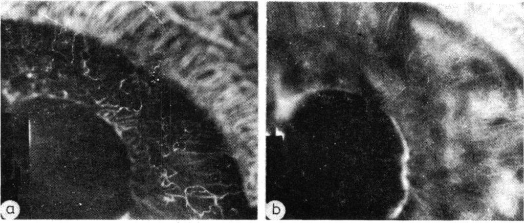 Rheumatoid arthritis for 50 yr 0 Left eye enucleated because of secondary glaucoma 7 yr earlier. arteries (Fig. 6a). Furthermore these vessels leaked fluorescein (Fig. 6b).