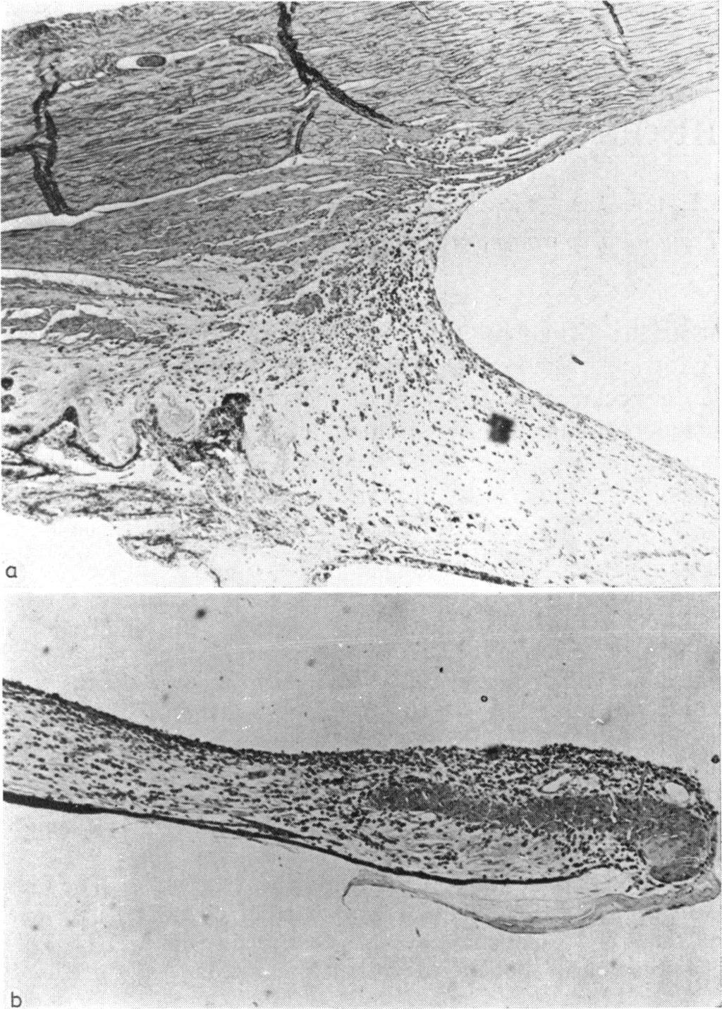 F-v ;-- 8ti'4.A ; t Vascular changes in the iris in chronic anterior uveitis w:f Fig. 7 Case 6, left eye. Sections from chamber angle (a) and central part of the iris (b).