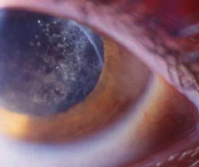 The posterior segment was barely visible but no major lesions could be seen, and OCT showed that there was no major loss of architecture of the macular retina.