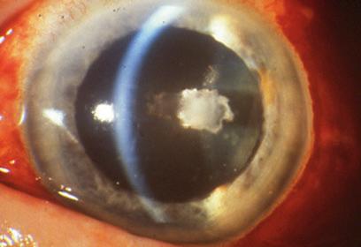 In children pars planitis can initially present with an anterior participation and can be mistaken for an anterior uveitis if the posterior segment is not carefully examined.