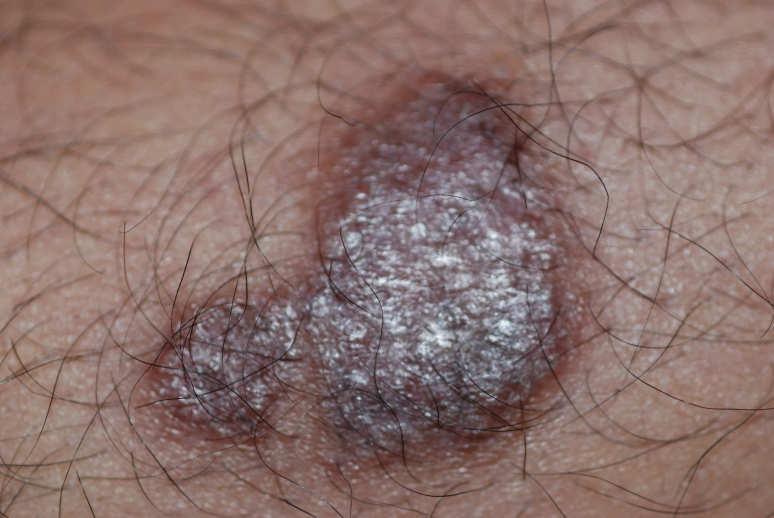 Case example 36 year-old man with history of Behcet s associated panuveitis with vasculitis Controlled well with infliximab for 5 years Complained of fever, cough and chills and new rash Humira