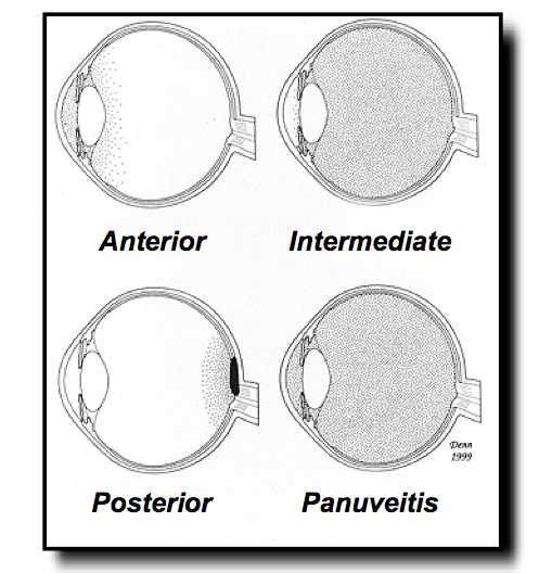 Anatomical location of inflammation Clinical Course of Uveitis Anterior uveitis Majority of uveitis cases 70% in Northern California population-based study Typically can be treated with