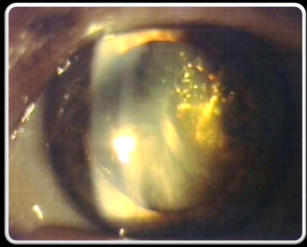 Complicated cataract