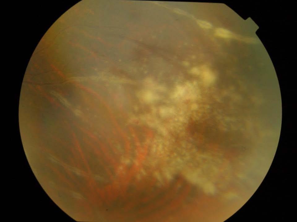 Posterior uveitis CMV retinitis granular