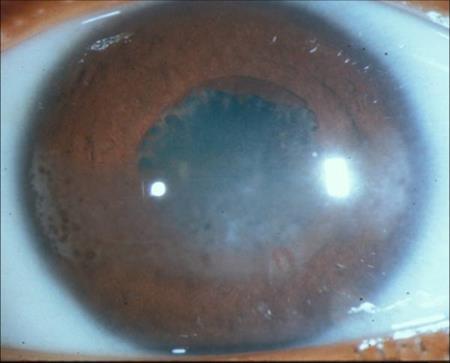 Epidemiology Uveitis is the 3 rd leading cause of blindness in USA 5-10% of uveitis cases