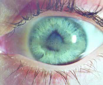 Note: White eye, White cataract, Band Keratopathy, Posterior
