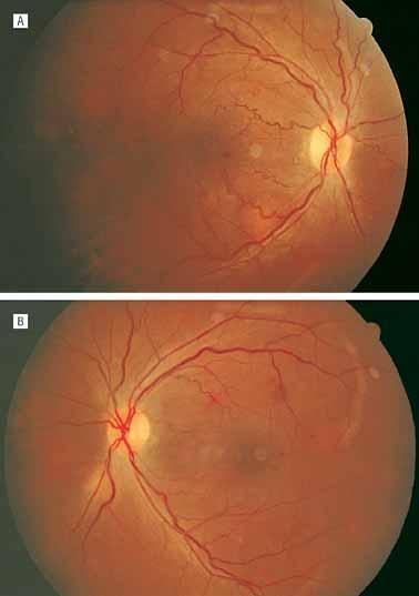 Fundus appearance (right eye [A], left eye [B]) following treatment with antifungal therapy for 3 weeks, showing partial