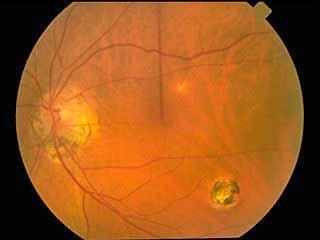 Ocular Histoplasmosis Note: PPA,