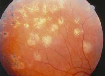 Multifocal Choroiditis with