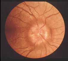 Sarcoidosis Atypical Optic