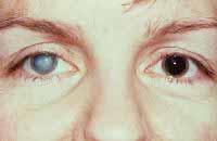 Heterochromia,