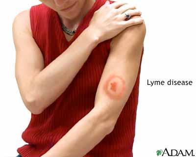 Lyme Disease Erythema