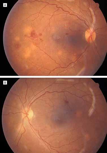 Fundus appearance in the right eye (A) and left eye (B) after 2 days of therapy showing multiple choroidal lesions approximately 0.5 to 1.