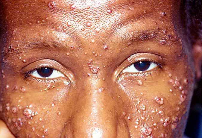 Cutaneous cryptococcal rash consisting of multiple papules, some with an umbilicated appearance, which can