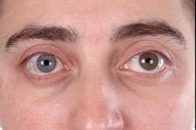 Fuch s heterochromic iridocyclitis Chronic unilateral uveitis Iris changes Atrophy Heterochromia